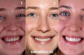 Виниры больно ли устанавливать