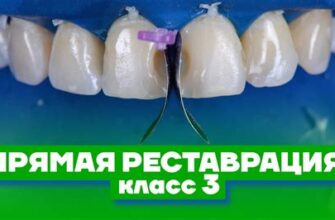 Восстановление зуба виниром прямой метод