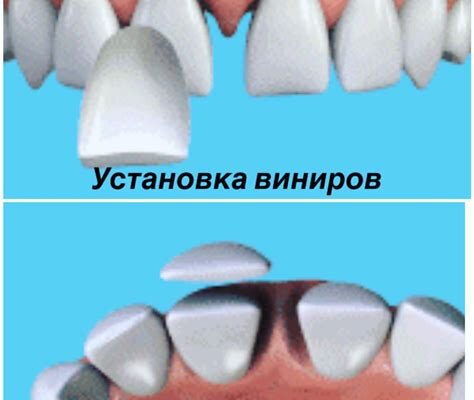 Виниры - пошаговая инструкция