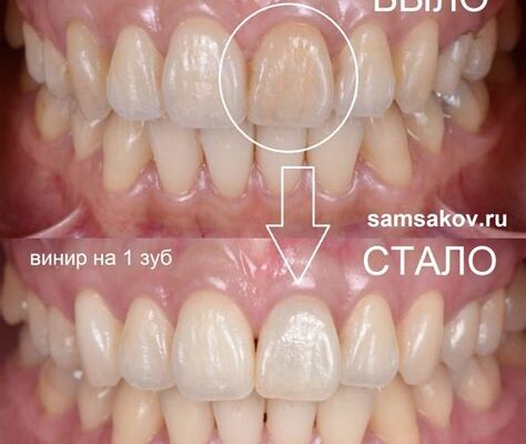 Виниры на здоровые зубы - установка