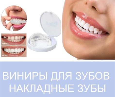 Сколько стоят виниры в Ростове