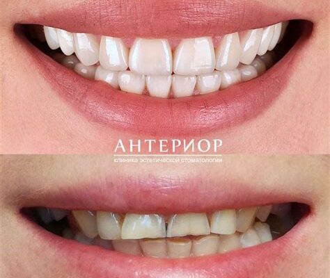 Сколько стоят виниры в Беларуси