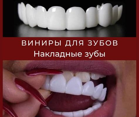 Виниры на зубы что это