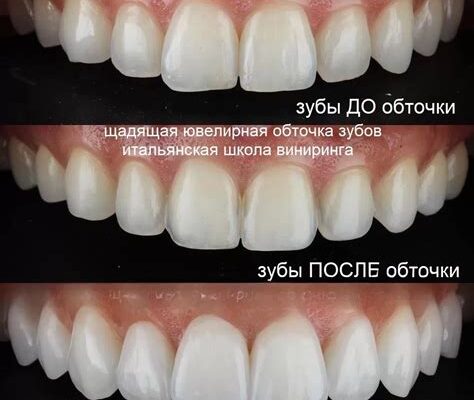 Безболезненная реставрация винирами