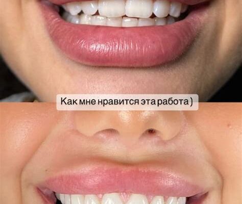 Надеваем силиконовые виниры правильно