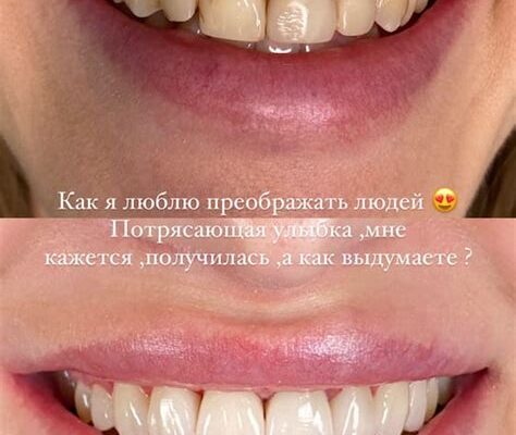 Виниры УФ Защита