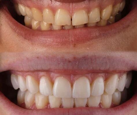 Стоимость передних виниров