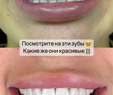 Меняют ли виниры цвет