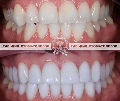Цельнокерамические виниры Emax - преимущества